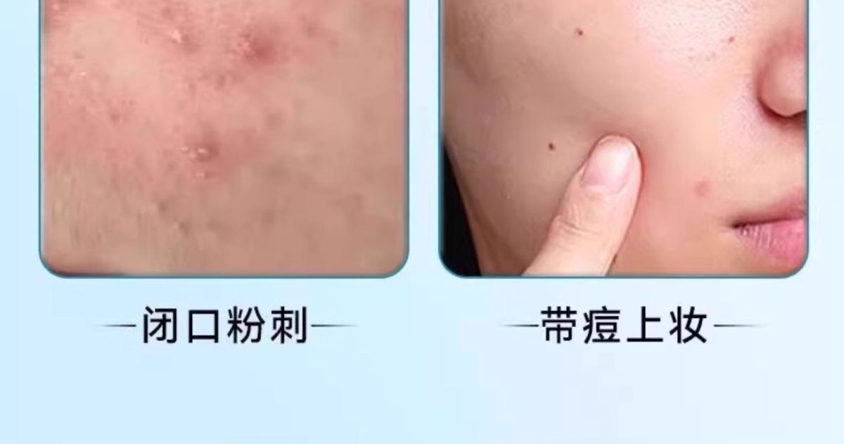 Xingxing akne bandı yıldız şekli teriye dayanıklı makyajlanabilir