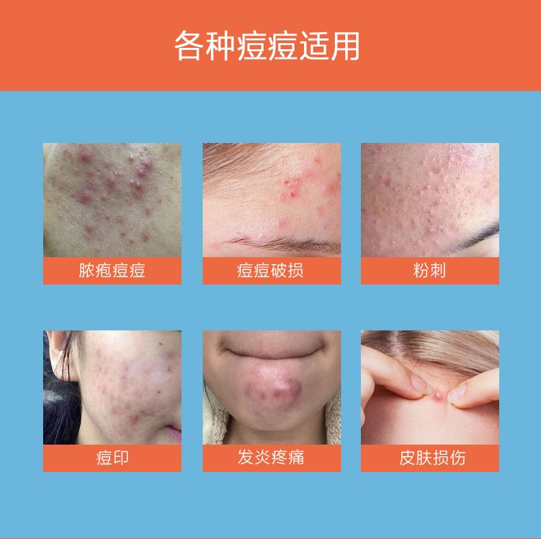 定制跨境新款紫外线变色贴纸UV感光变色贴痘痘贴透明感光变色贴