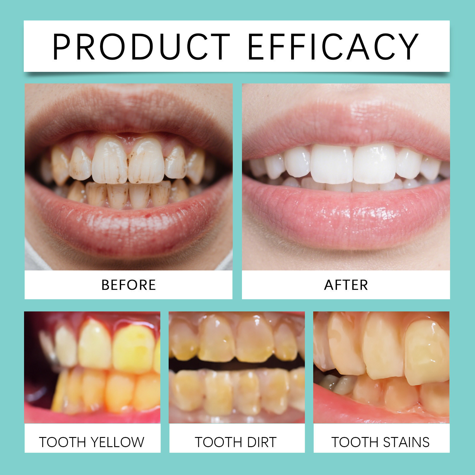 Teeth care gel pen for tartar and stain removal