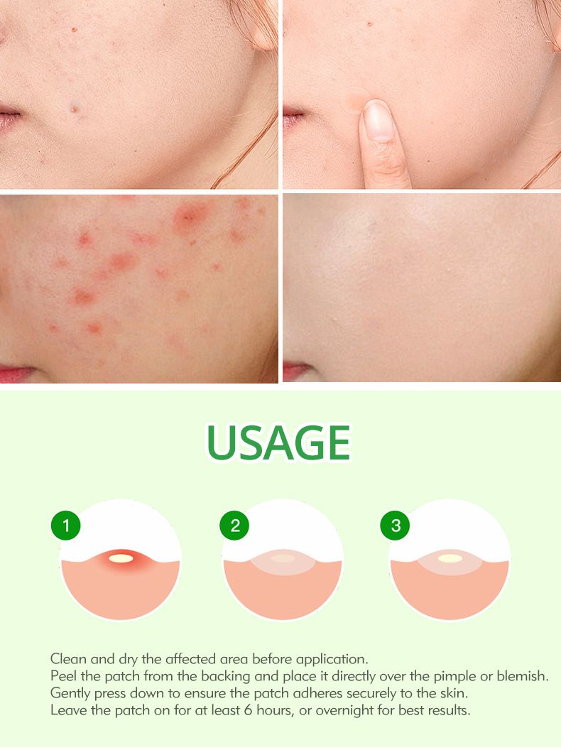 Guanjing acne patch, invisible, breathable