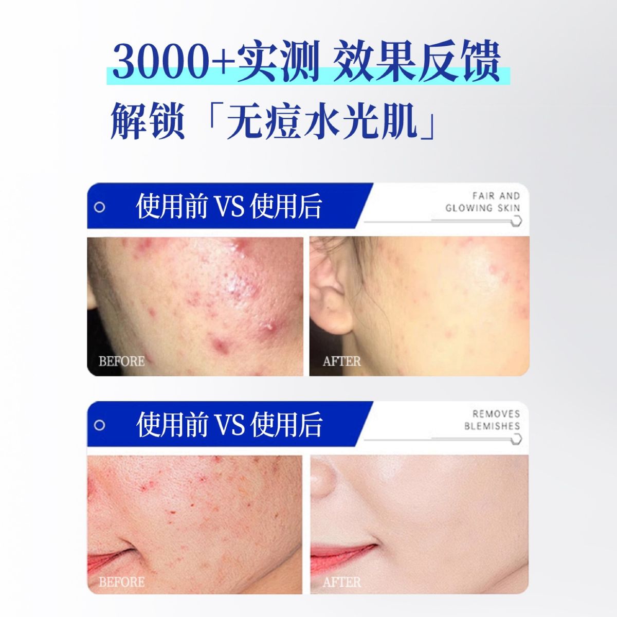臻羞水杨酸祛痘贴隐形半透明遮痘净痘贴轻薄型痘痘贴厂家直销批发