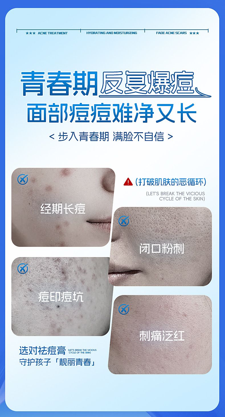 Acne Cream, Fade Acne Marks, Moisturizing