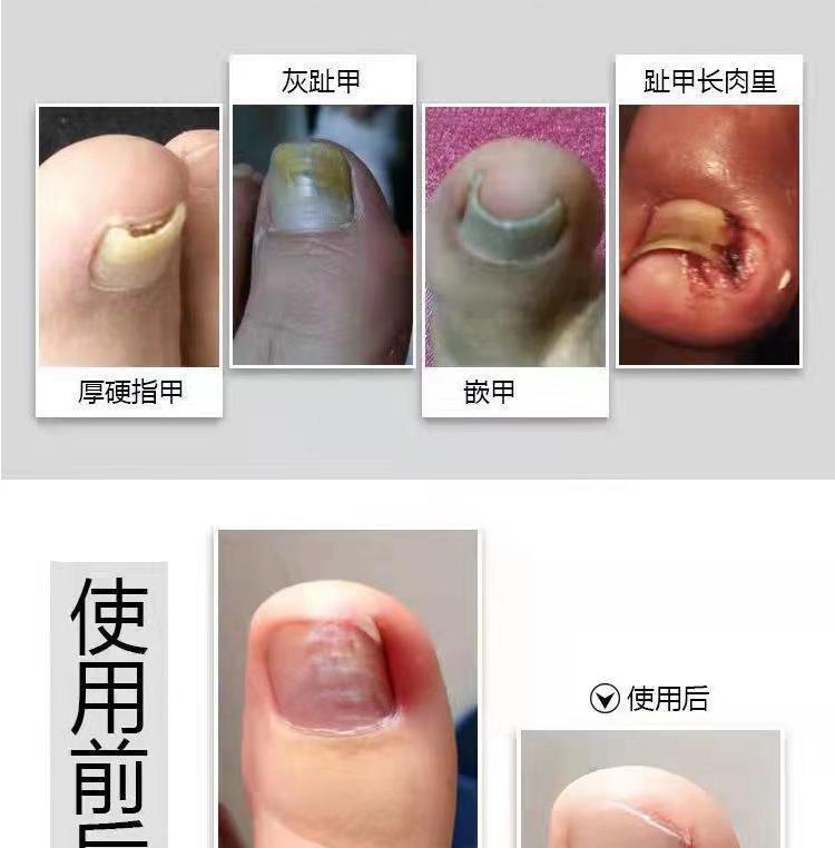 İngrown toenail makası, profesyonel sivri ucu