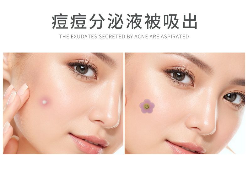 Acne patches, hydrocolloid, multicolor, concealing formula