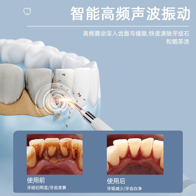 156声波洁牙器电动牙刷洁牙仪去除牙结石烟渍口腔清洁神器美牙仪