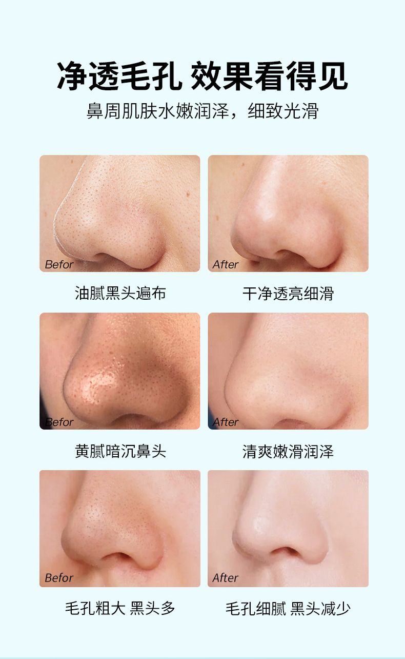 MAIGOOLE nose mask blackhead and acne cleansing pores