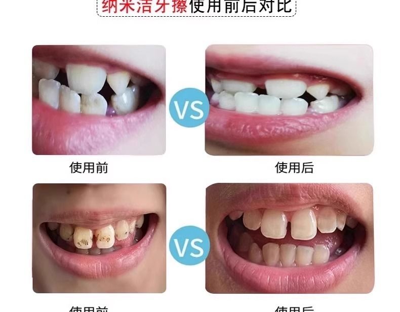 Nano teeth cleaning wipes for adults and children