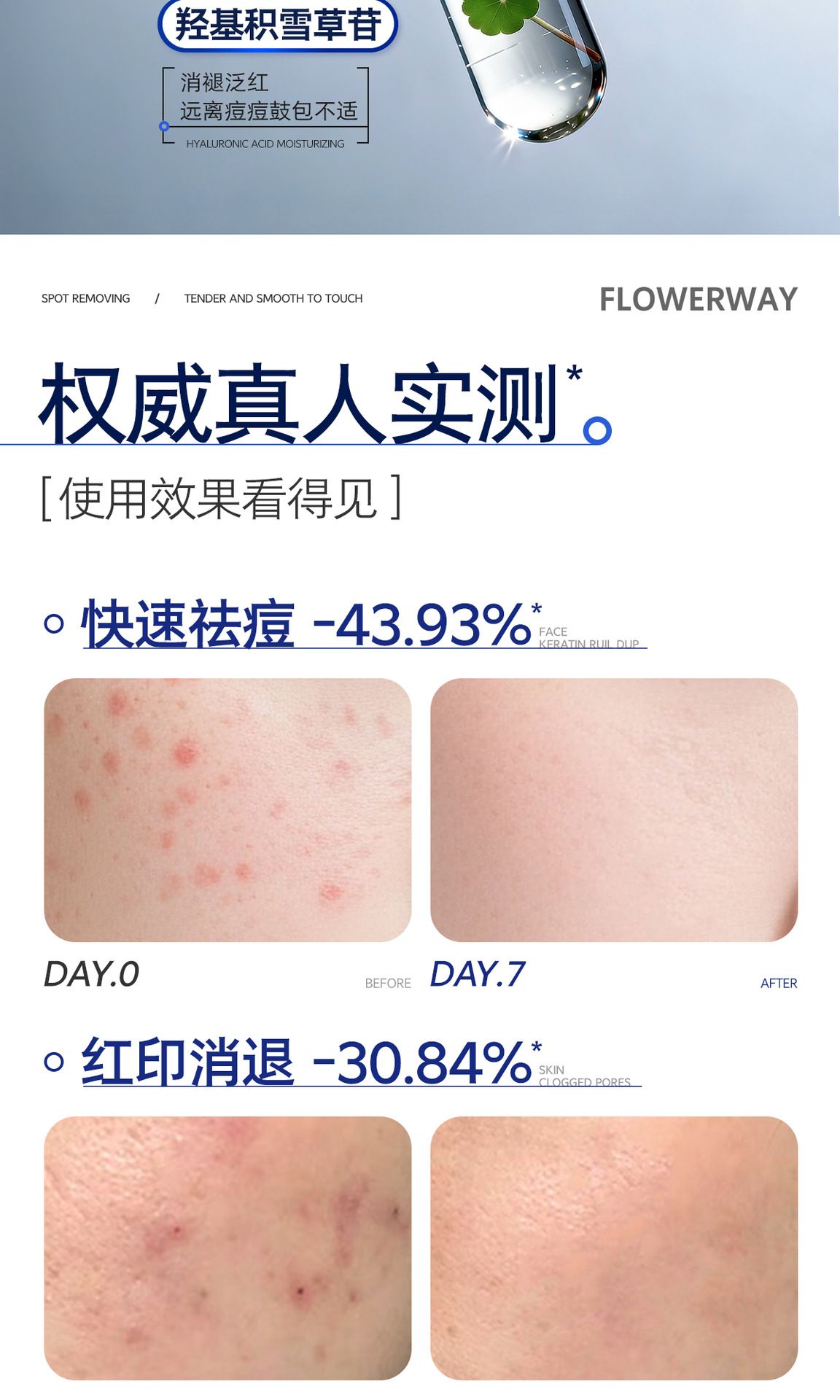 FLOWERWAY痘痘贴吸脓遮瑕隐形祛痘贴可化妆日夜两用水胶体痘痘贴