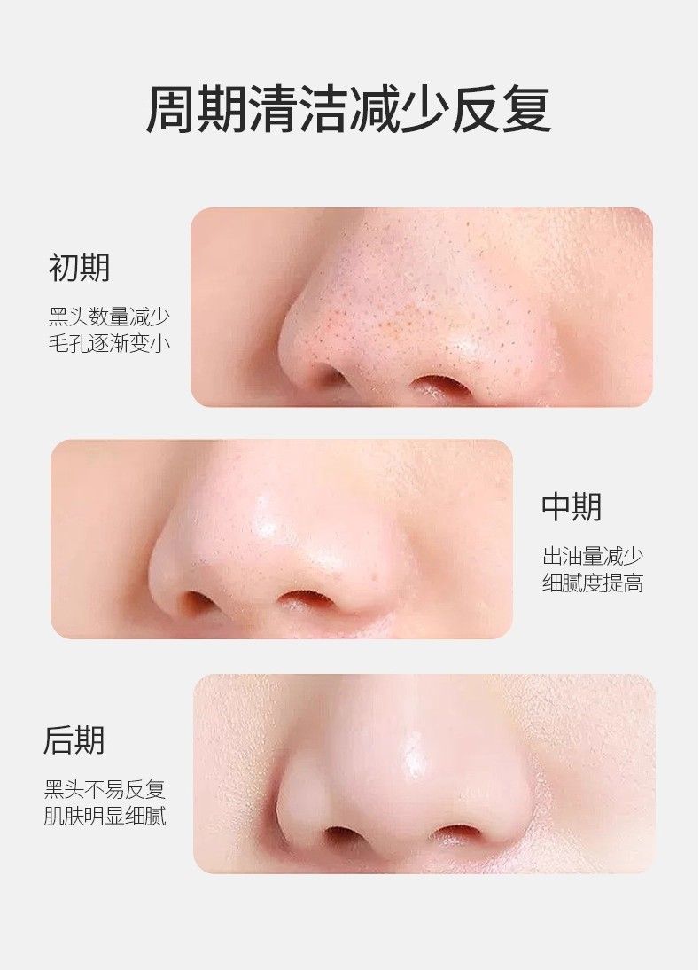 Tongyan Ji Mitesser-Nasenstrips-Set, Tiefenreinigung