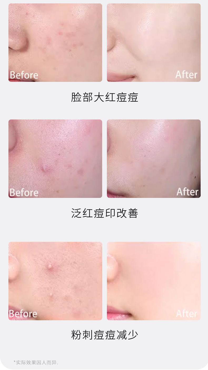 Electronic acne patch with physical pus absorption, lightweight and breathable