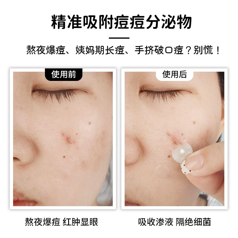 厂家批发水胶体精油款痘痘贴翠花爆款热卖款防水遮痘贴上妆人工皮