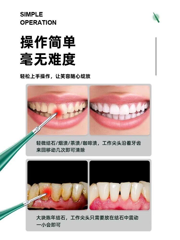 洗牙仪超声波牙结石去除器去黄牙垢口臭牙渍神器电动牙刷冲洁牙器