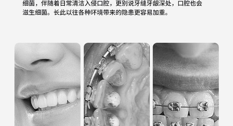 超声波高压冲牙器洗牙器便携式家用电动专用正畸水牙线洗牙神器