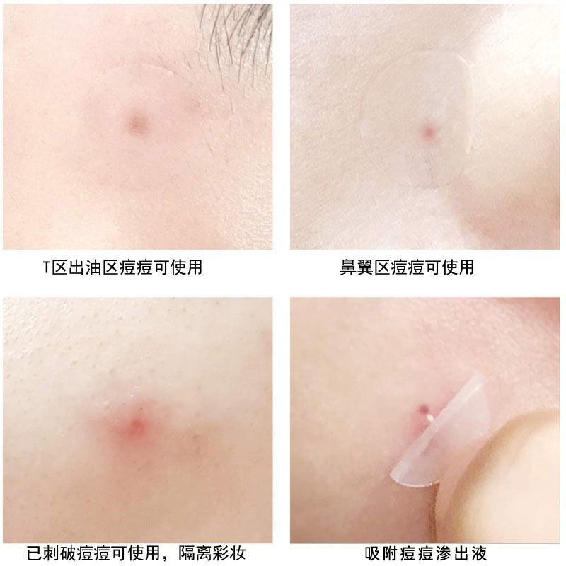 彩色痘痘贴星星隐形痘贴轻薄水胶体痘印贴亲肤遮瑕痘坑异形痘痘贴