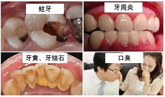 Ultrasonik diş temizleyici, sigara lekeleri ve diş taşı çıkarıcı