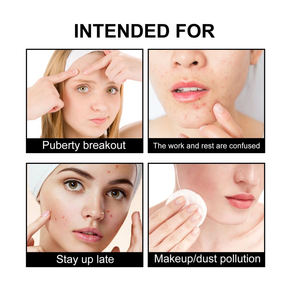 Hoygi Cute Black Acne Patch Reduces Spots Blackheads Pimples Fades Acne Balances Skin Tone Acne Sticker