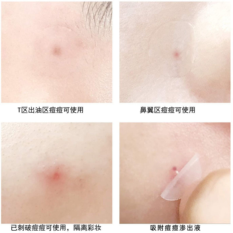 Colorful Pimple Patch Star-Shaped Invisible Acne Patch Thin Hydrocolloid Blemish Patch Skin-Friendly Concealing Acne Scar Irregular Pimple Patch