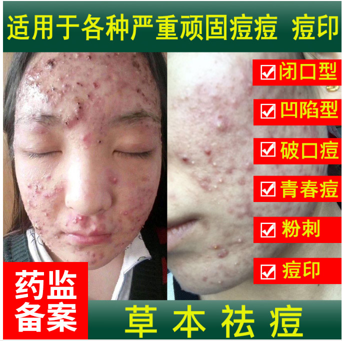 Herbal Acne Treatment, Reduces Acne Marks and Blackheads, for Men and Women