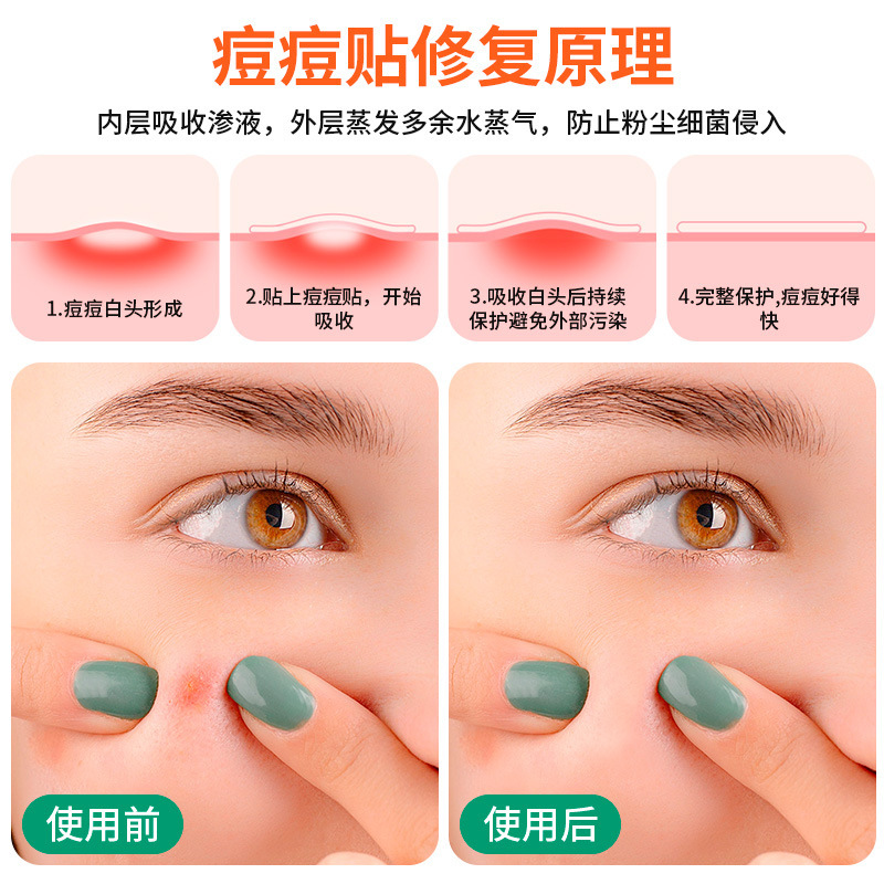 批发定制彩色星星款水胶体痘痘贴人工皮痘贴隔离细自发热技术