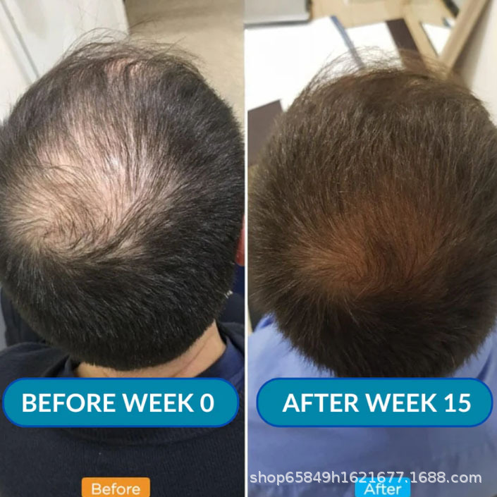 Advanced Micro-Infusion Hair Regrowth Kit Hair Growth Microneedle Serum