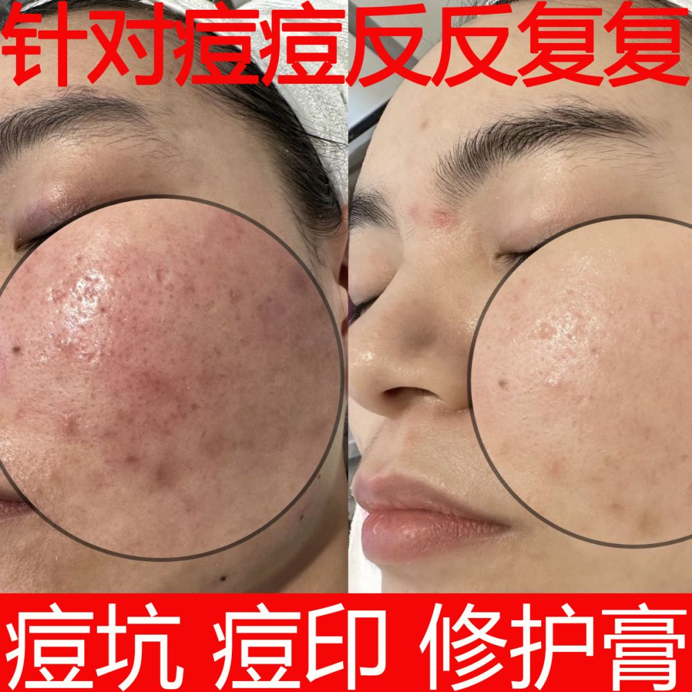 Herbal acne cream with scar fading formula