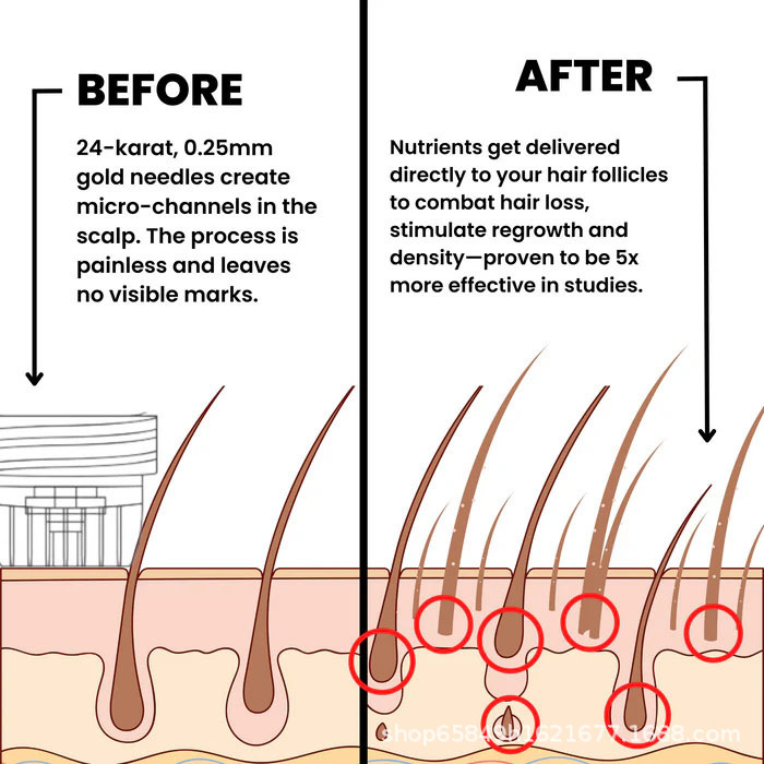 Advanced Micro-Infusion Hair Regrowth Kit Hair Growth Microneedle Serum