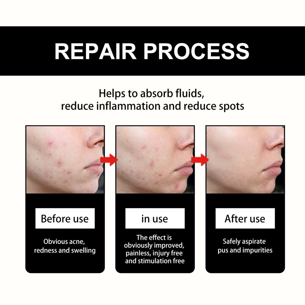 Hoygi Cute Black Acne Patch Reduces Spots Blackheads Pimples Fades Acne Balances Skin Tone Acne Sticker