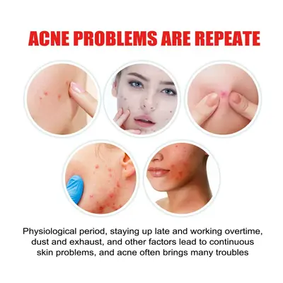 Jaysuing Acne Patch for Closed Comedones - 2