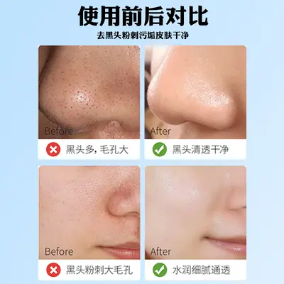Blackhead Removal Nose Strips, Deep Cleansing for Men and Women - 5