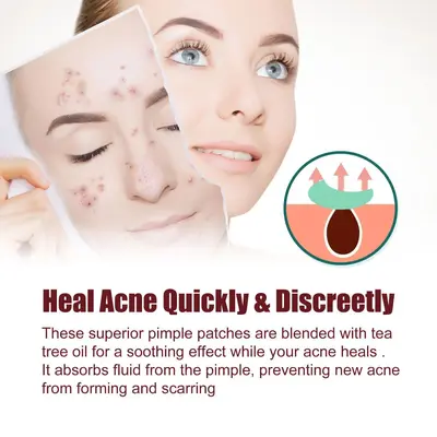 Jaysuing Acne Patch for Closed Comedones - 3