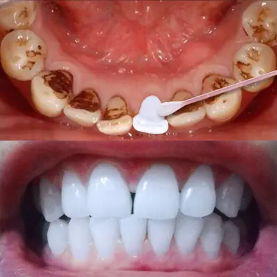 Tooth Stain Remover Powder for Yellow Teeth Smoke Stains and Tartar - 2