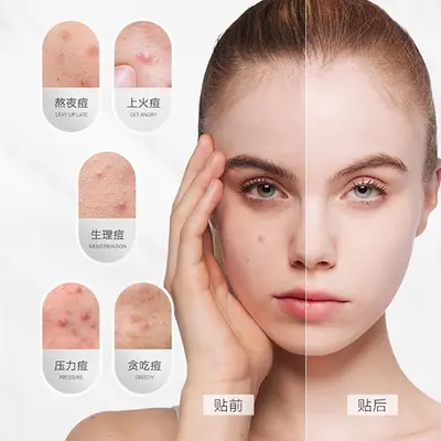 Akne-Pflaster ultradünn Make-up Tag und Nacht