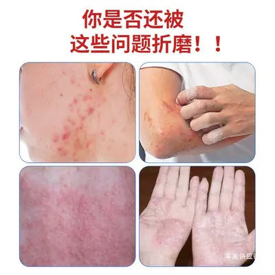 Japanese Rose Acne Cream, Removes Acne Scars and Blackheads