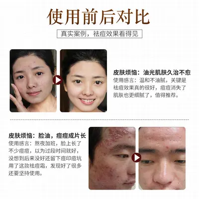 草本高端祛痘膏去青春痘粉刺闭口男女通用温和淡化痘印痘坑祛痘霜