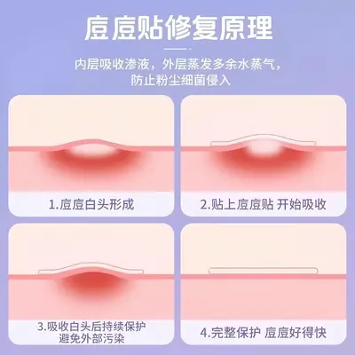 星星痘痘贴型遮盖痘印隐形可上妆防汗水可爱物理吸脓水胶体痘印贴