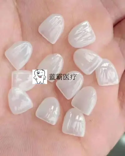 全瓷美牙贴面 牙齿贴片全瓷贴片私人美牙贴冰瓷蓝瓷琥珀瓷贴片