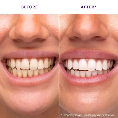 V34 Whitening Strips, Gentle Daily Teeth Cleaning - 3