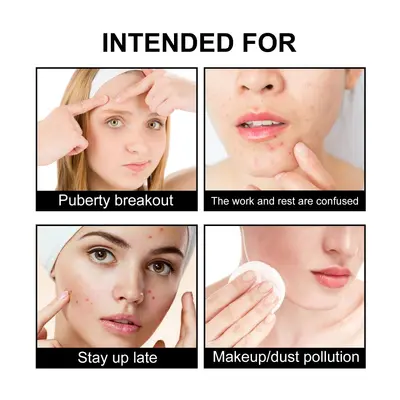 Hoygi Cute Black Acne Patch, Reduces Spots and Pimples