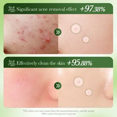 SADOER Salicylic Acid Centella Transparent Acne Patch for Teens - 5
