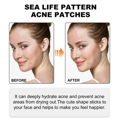 Limited-time discount Jaysuing cute colorful acne patches, fade pimples and blackheads, care for facial skin, concealer