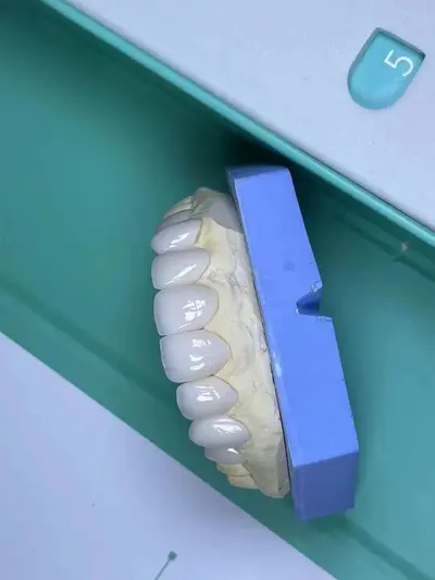 美牙全瓷贴片团队学习瓷片材料牙贴美牙玻璃瓷牙齿贴面牙齿美白 - 5