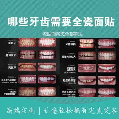 Yiohjia All-Ceramic Dental Veneer Porcelain Laminate, Blue Ceramic, Amber Ceramic, Lingxi Ceramic, Handmade Porcelain, Fluorosis Teeth Whitening Teeth - 3