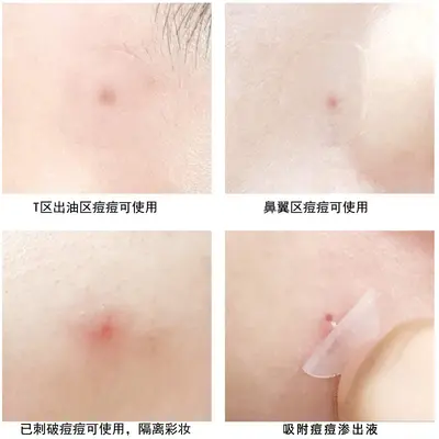 Star-shaped colored pimple patches, thin hydrocolloid