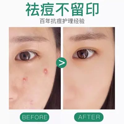 Mentholatum Clean & Clear Acne Healing Invisible Spot Patch 26 pcs Gentle Soothing Repair - 4