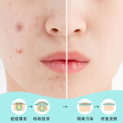 定制卡通痘痘贴pimplepatch痘痘贴 印刷款隐形净痘贴轻薄痘痘贴