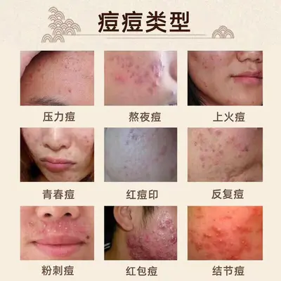 祛痘膏淡化痘印去粉刺修护敏感肌补水保湿滋润清爽面部精华祛痘膏