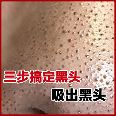 去黑头鼻贴套盒T区祛粉刺收缩毛孔黑头导出液去黑头的鼻贴鼻头贴
