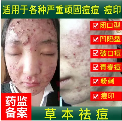 Herbal Acne Treatment, Reduces Acne Marks and Blackheads, for Men and Women - 1