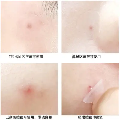 Hydrocolloid Pimple Patch with Spike, Pus Absorbing, Invisible - 5