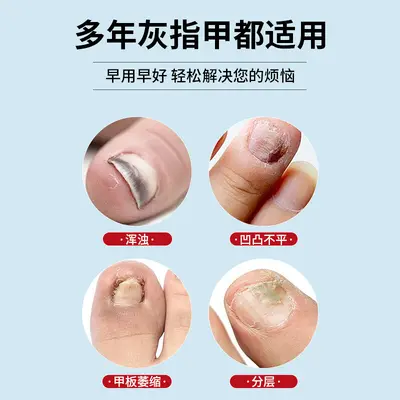 Gray nail pen, gray nail antibacterial gel, nail protection and care all in one, no need to remove nails, nail repair, wholesale and distribution.